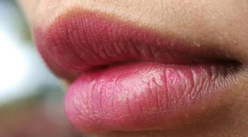 Buze crăpate: ce vitamină îți lipsește din organism?