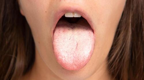 Ce să faci dacă ți ai ars limba: 9 metode simple pentru limba arsă