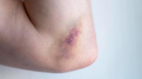 În cât timp se vindecă o vânătaie și cum o tratezi corect