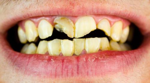 România, codașă la finanțarea stomatologiei, arată OCDE. Avertismentul CMSR: 66% dintre copii și 64% dintre adulți au carii