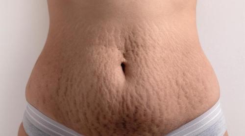 Ingredientul care șterge vergeturile roșii. Rezultatele i au uimit pe dermatologi