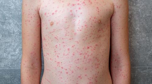 Marea Britanie și a pierdut statutul de țară liberă de rujeolă