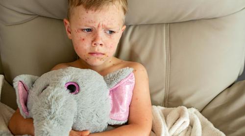 Miturile periculoase despre rujeolă și vaccin. Dr. Mihai Craiu: „Cei care încă mai cred că este mai bine să facă boala, aș vrea să îi rog să mergem împreună la cimitirul din Slănic Prahova”