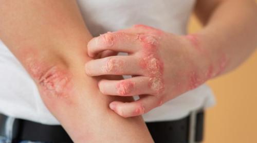 Scabie (râie): ce este și cum se transmite. Simptomele încep în 4   6 săptămâni