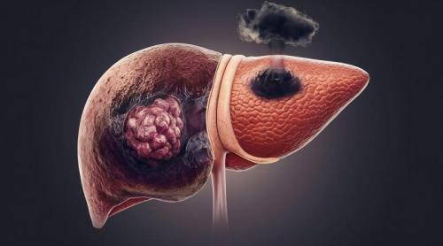 Cancerul de ficat, prezis cu o acuratețe de 93% printr un nou scor de risc