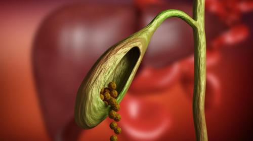 Ce se întâmplă dacă ai pietre la fiere și NU scoți colecistul. Cele 2 întrebări care m au măcinat. Părerea dură a unui medic m a convins: Se împrăștie în tot corpul