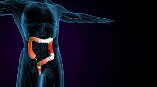 România, aproape de topul UE la cancer colorectal