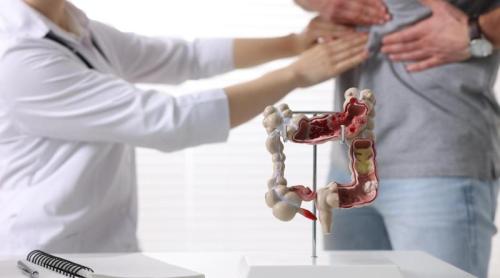 Semnul din intestin care crește riscul de cancer colorectal