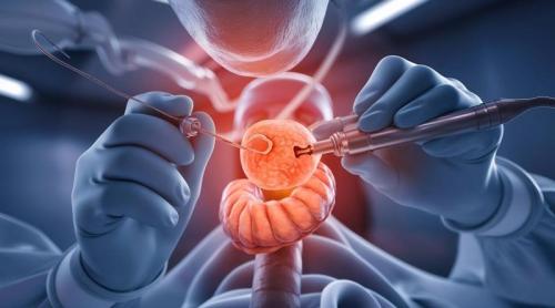 Tratamentul care reduce riscul de recidivă în cancerul de colon