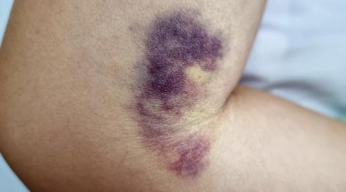 Ce înseamnă când o vânătaie este verde sau neagră. Primul semn să mergi la medic