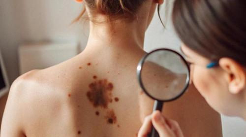 Cum ajunge melanomul să dea metastaze la inimă, deget sau stomac. Dr. Tudor Ciprut: Migrează în orice țesut