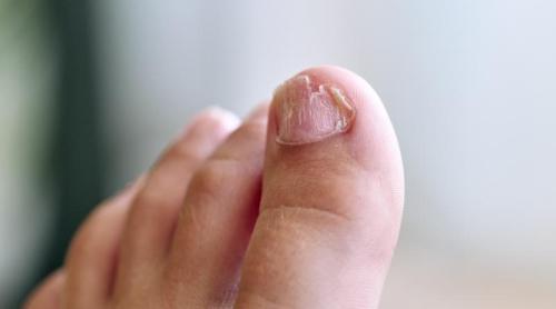 Cum să recunoști o unghie încarnată infectată