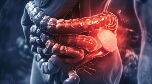 De ce crește alarmant numărul cazurilor de cancer colorectal sub 65 de ani