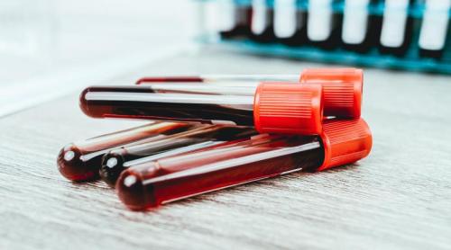 MethylScan, testul de sânge ieftin care depistează cancerul înainte de apariția simptomelor