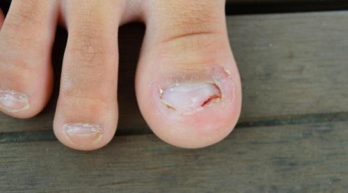 Unghiile încarnate: de ce apar?