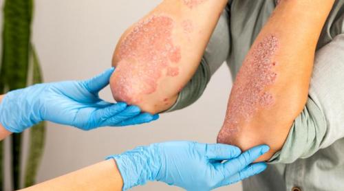 Care e diferența dintre psoriazis și eczemă și de ce apar