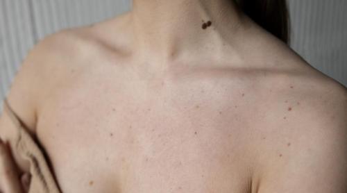 Care este diferența dintre petele solare și cancerul de piele?