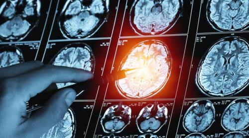 Metastazele cerebrale în cancerul de sân: ce simptome apar și când apare răspândirea la creier