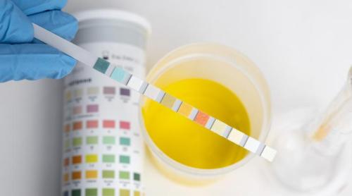 Proteine în urină, proteinuria: ce înseamnă și ce afecțiuni ascunde acest semn