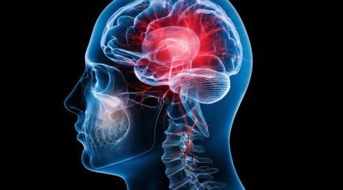 Studiul care schimbă tot ce știam despre accidentul vascular cerebral