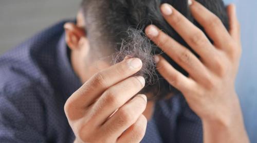 Tratarea căderii părului la bărbați: Cele mai eficiente două medicamente aprobate pentru alopecie
