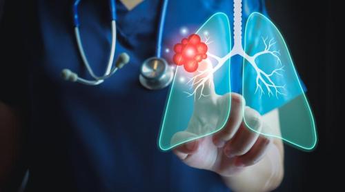 Imunoterapia postoperatorie cu Nivolumab, ineficientă în cancerul pumonar