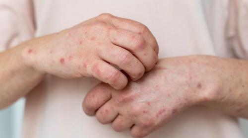 Vitamina A, folosită greșit împotriva rujeolei, a dus la creșteri masive de intoxicații