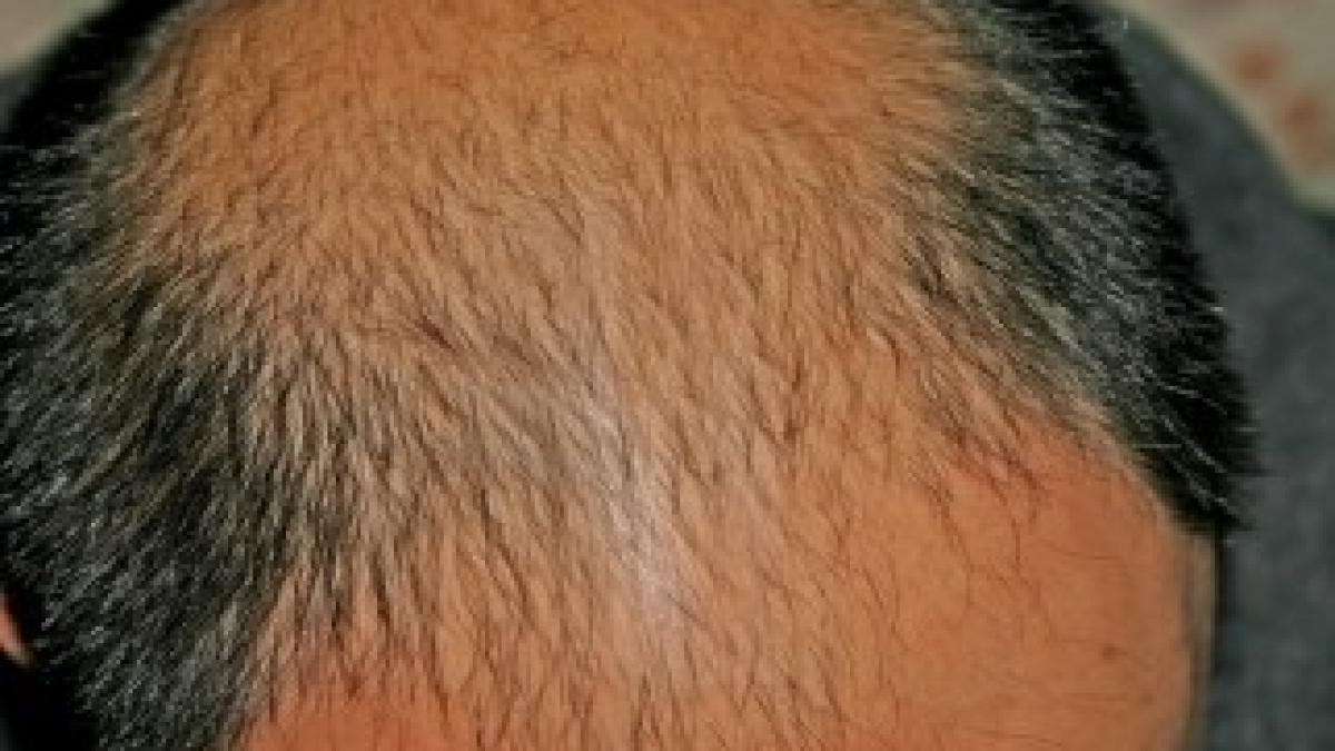 male-pattern-baldness