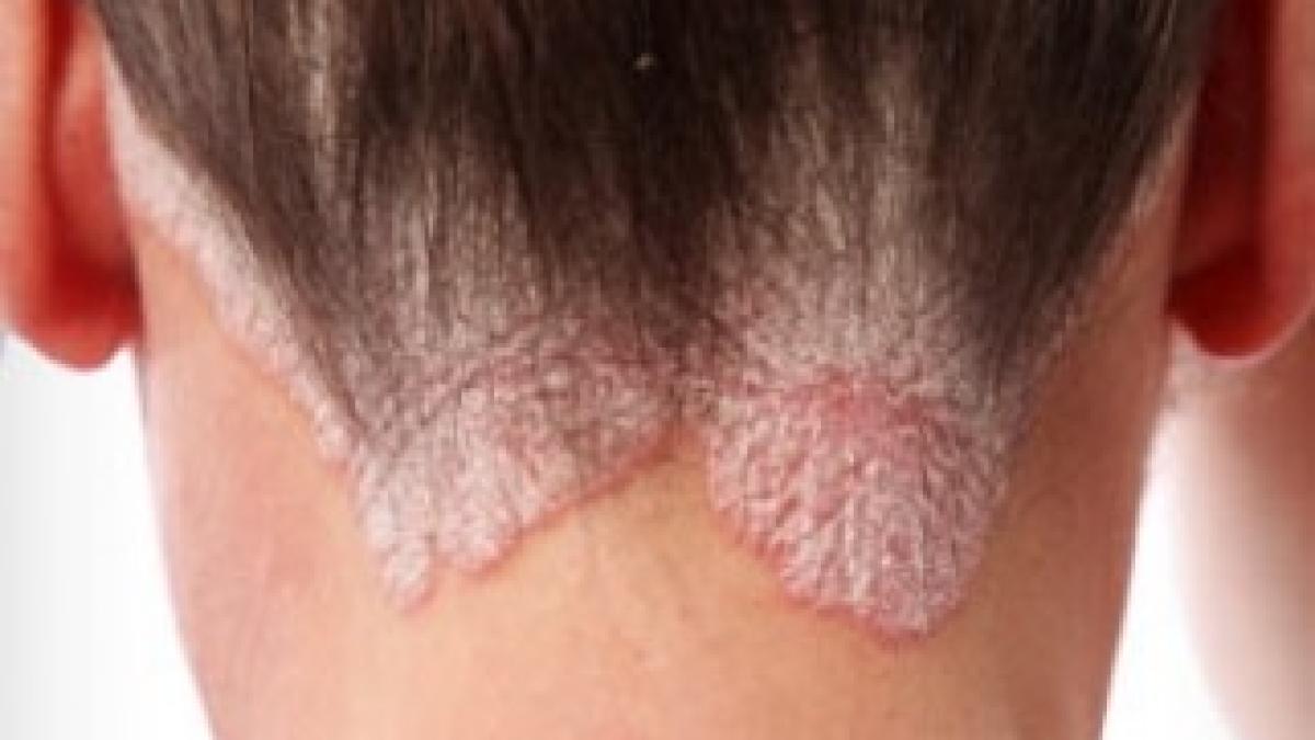 psoriasis-scalp