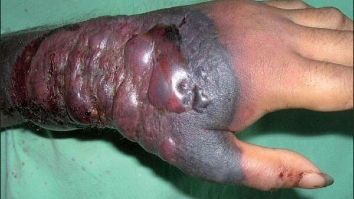 ebola_hand1_74765500