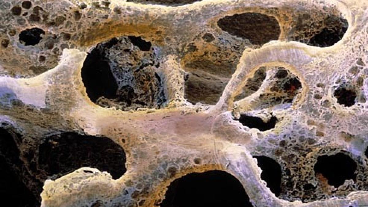 cancer_osos_60360000