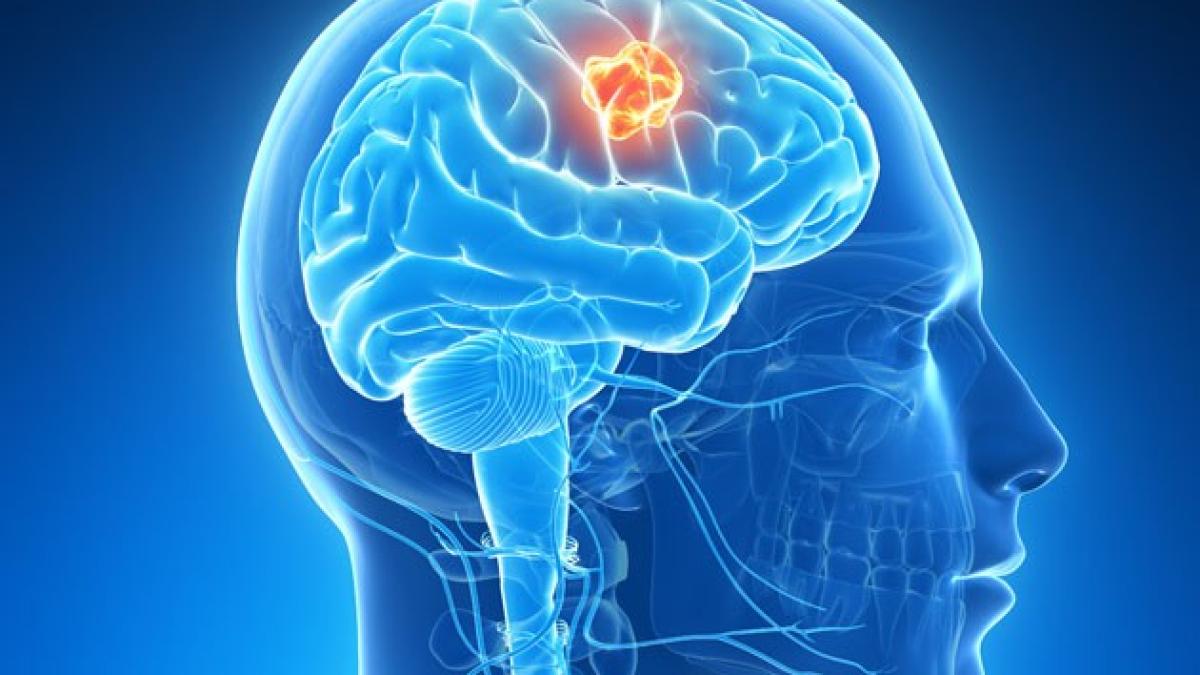 cancer_cerebral_17393100