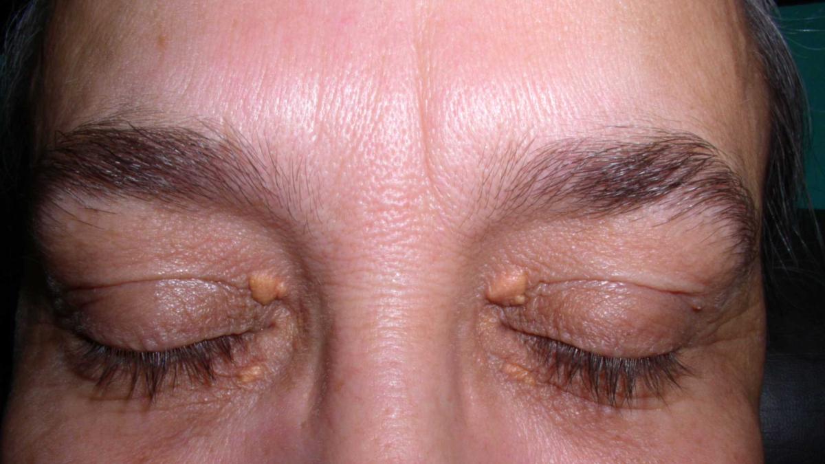 xanthelasma_43443900