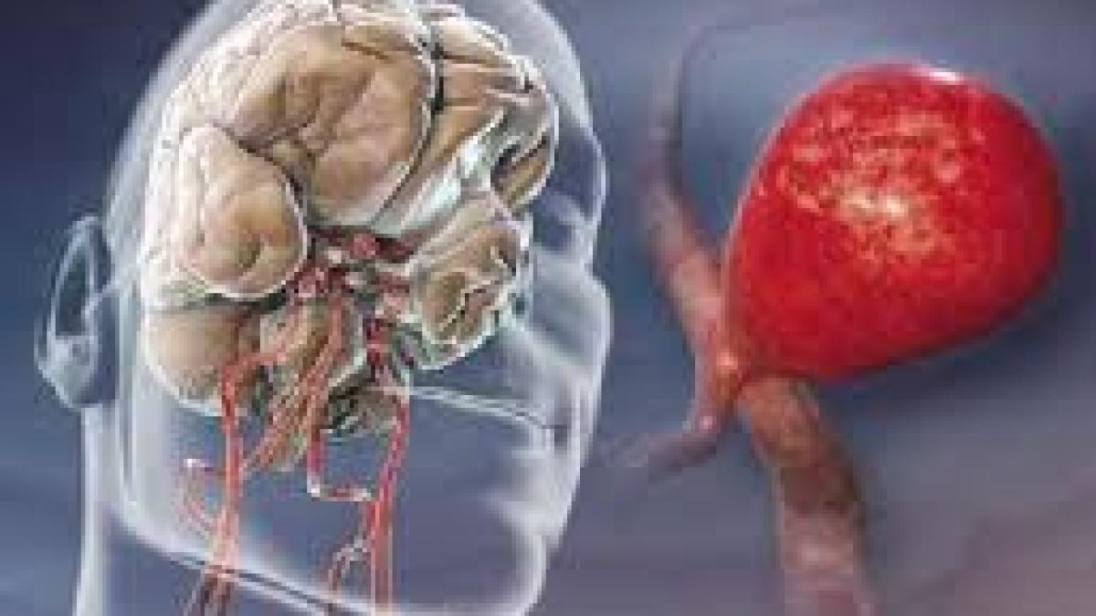 anevrism_lhjt_09842800