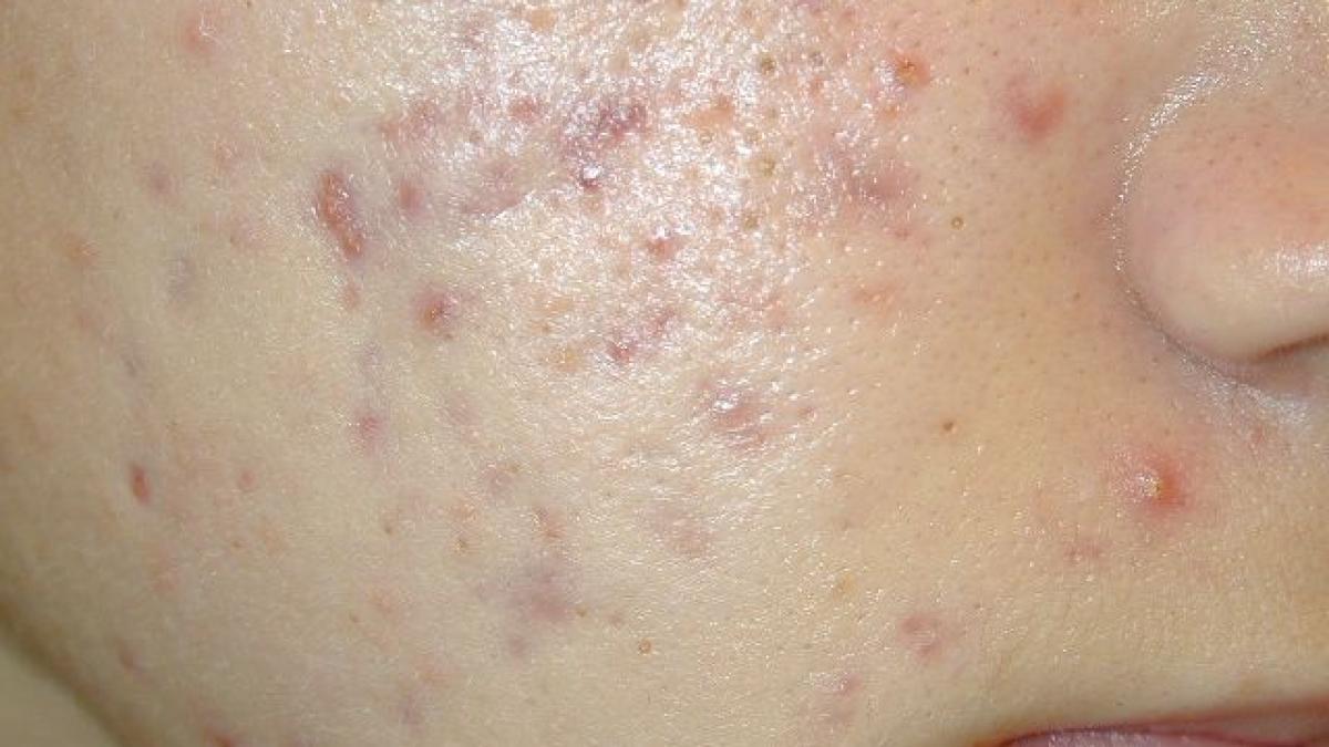 acnee_fata1_09849200