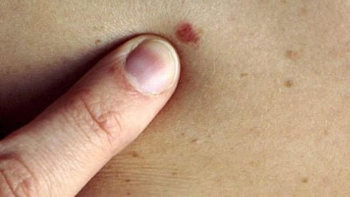 cancer_piele_29942600