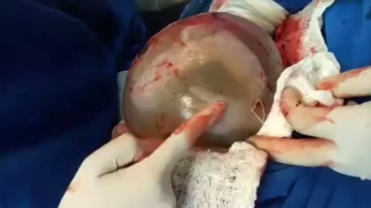 bebelus_nastere_sac_amniotic_49449100