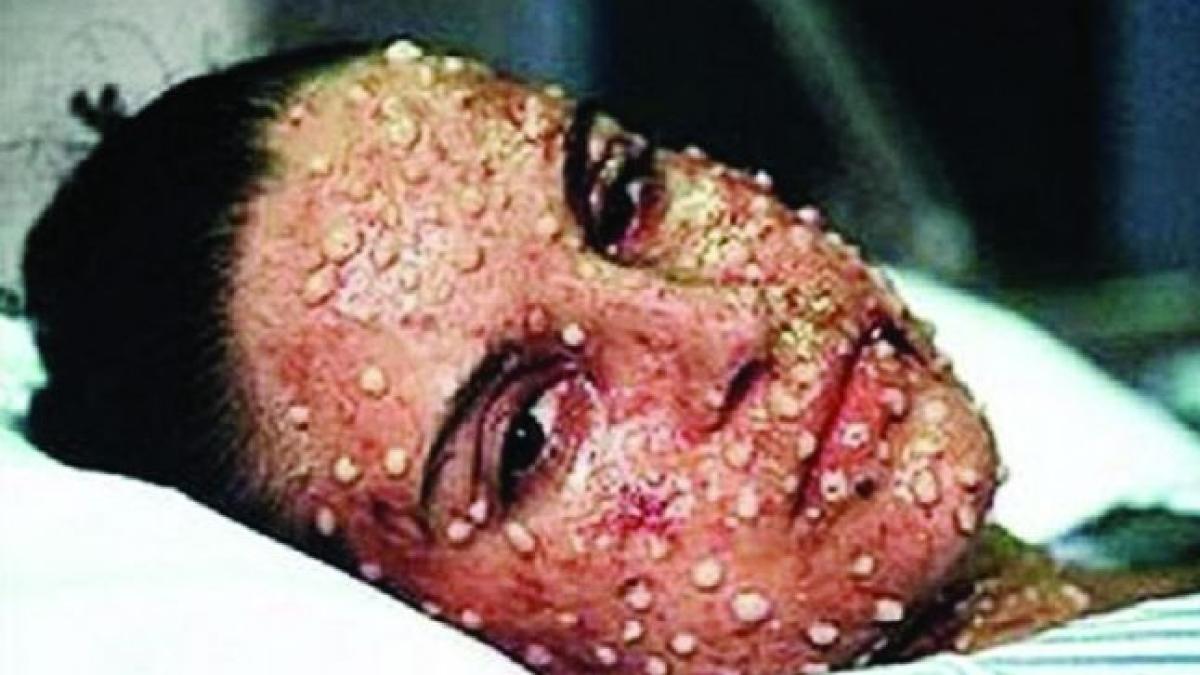 variola_imagine_fata_bube_pustule_44828500