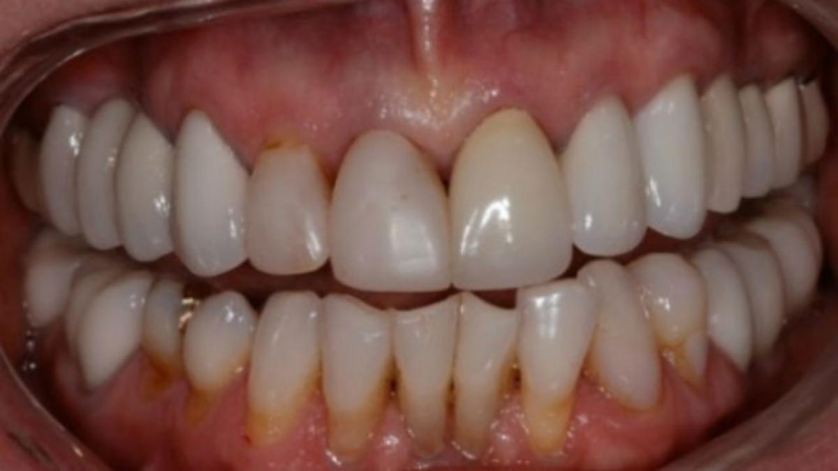 paradontoza_72780300