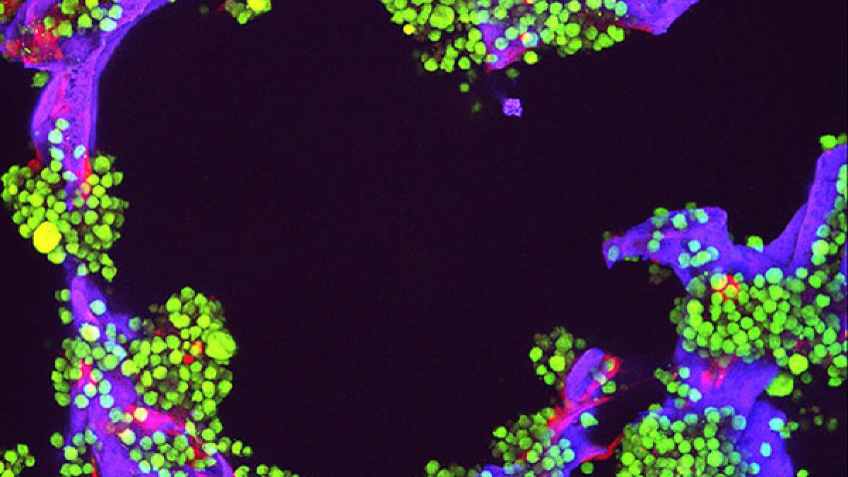 cancer_mielom_multiplu_15745600