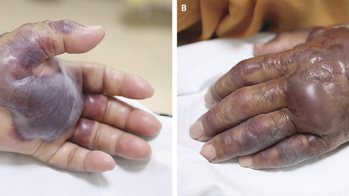 maini_infectie_55799200