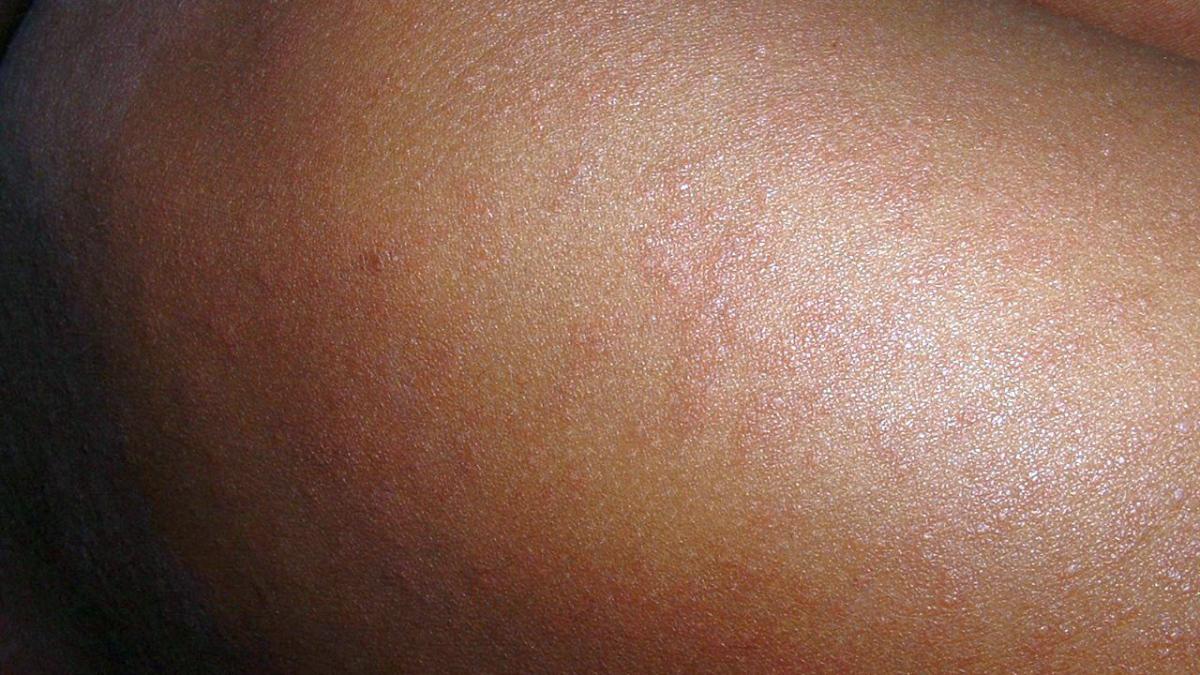 pojar_rujeola_98606100