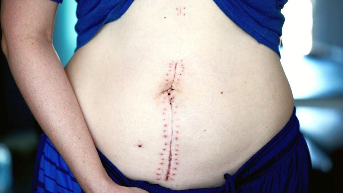 operatie-abdomen_44587600