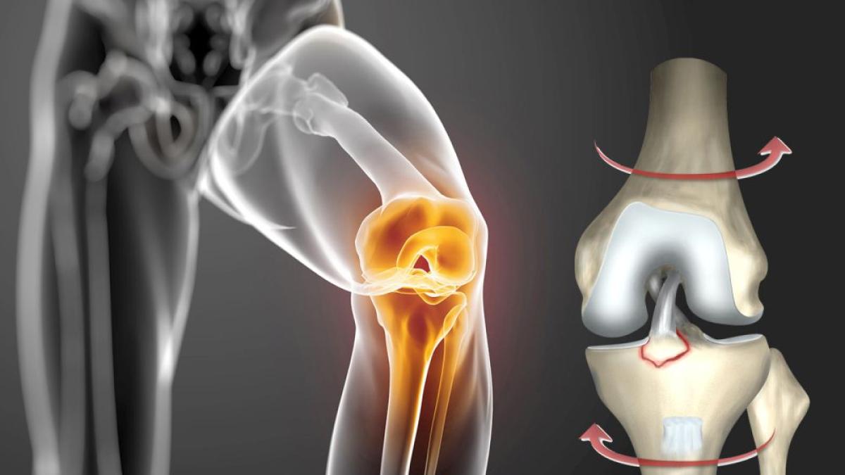 ruptura-ligament-incrucisat-foto-sanador_01150700