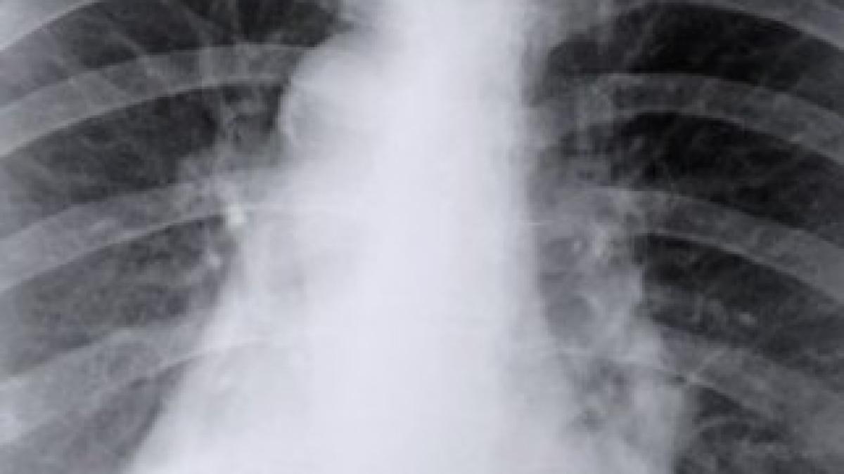 article-new_ehow_images_a06_er_2i_ppd-testing-tuberculosis_-800x800-e1332509660160