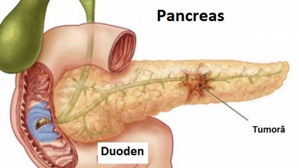 cancer_pancreas_13150800