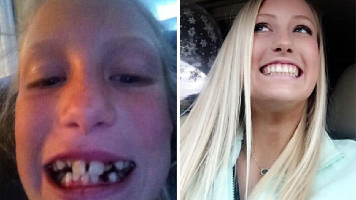 dental-braces-before-after-57-5925922f5a170__700_04934100