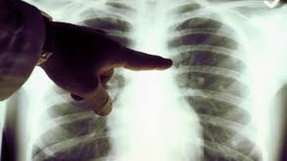 cancer_de_plamani_29094700