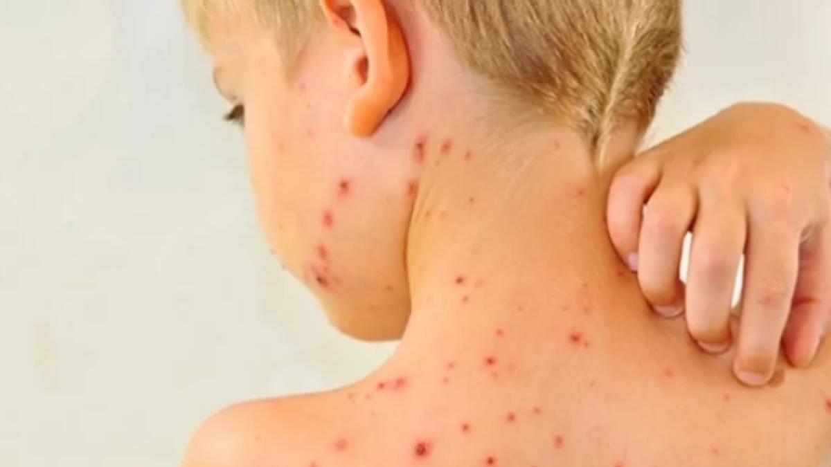 rujeola_dcnews_04428100