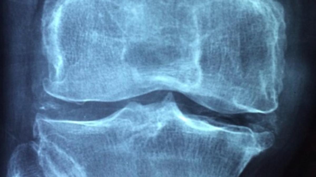 artrita_coronaviurs_medicament_66036400